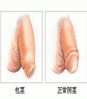 男科包茎手术前要做什么准备